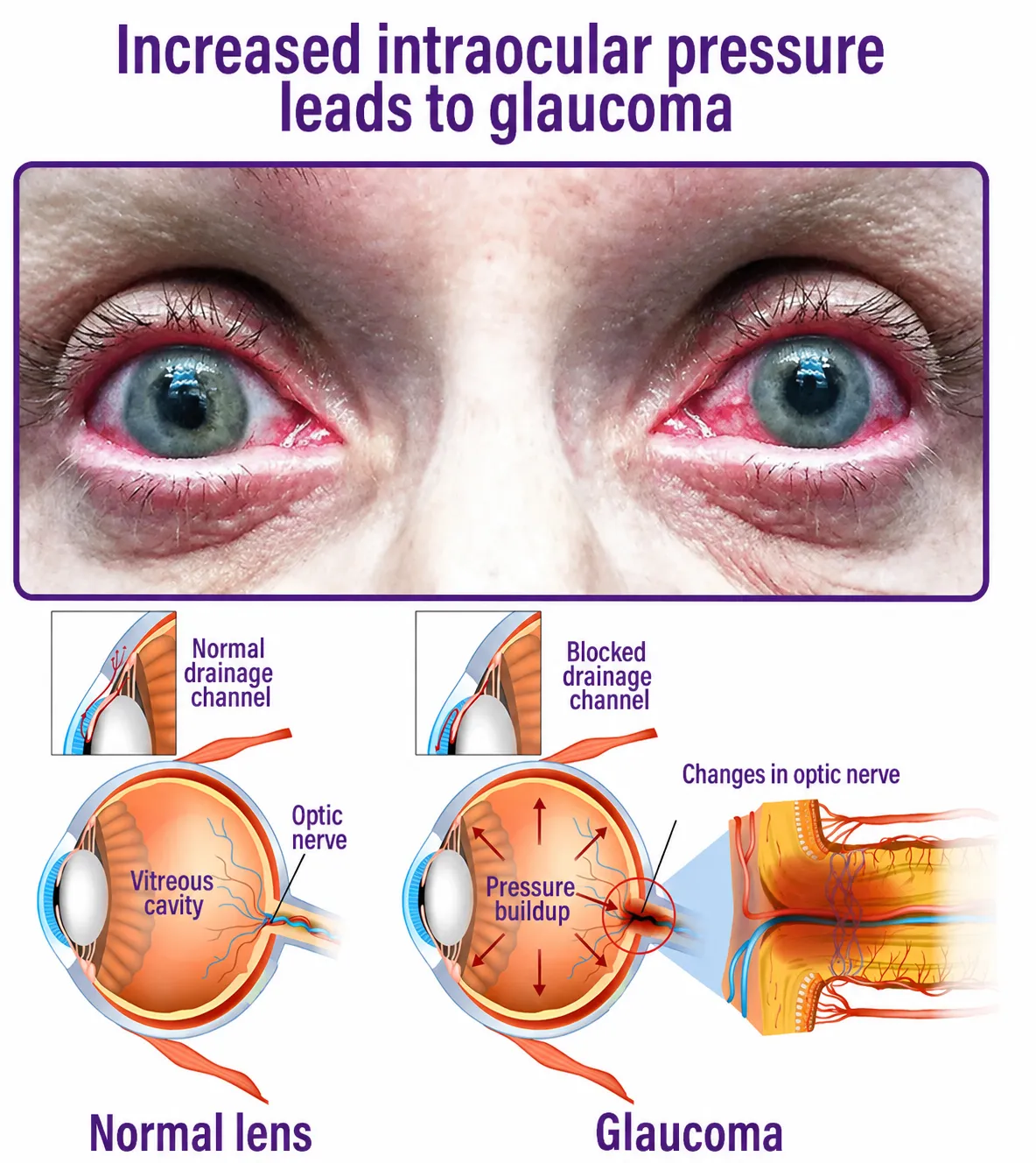 NEYEROS®👀Transdermal Vision-Repair Eye Microneedle Patch