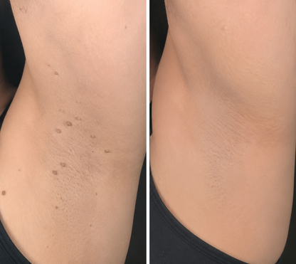 🔥Muwix®2-in-1 Microneedle & Hydrocolloid Patch🍀| Removes Raised Moles, Acne, Flat Warts & Skin Tags | Helps Improve Wrinkles, Scars & Blemishes | Invisible Patches for Face & Body